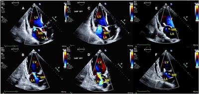 Usefulness of Intra-Aortic Balloon Pump Off Test With Echocardiography for Decision Making in Secondary Ischemic Mitral Regurgitation: A Case Report